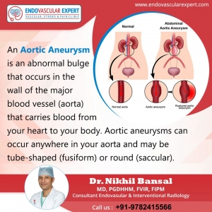 Consult with an interventional radiologist for Aortic Aneury